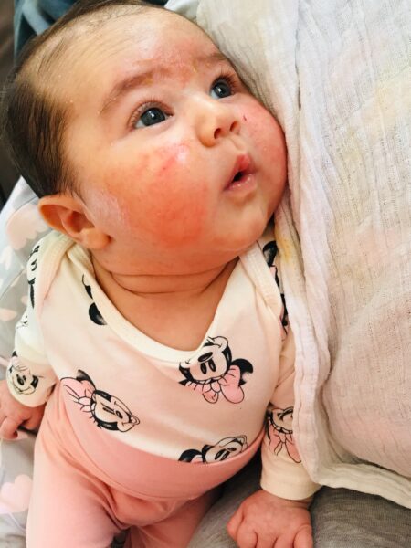 Propolis bei Babyakne